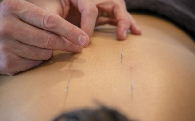 Acupuncture